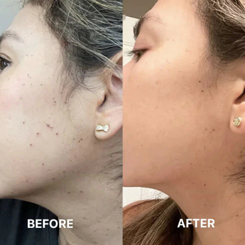 Portable USB Skin Tag Repair Beauty Kit